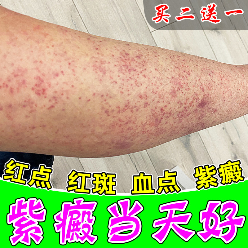 色素性小腿身上起红点血点软膏