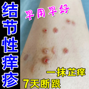 结节性痒专用冶顽固硬疙瘩全身皮肤痒外用软膏