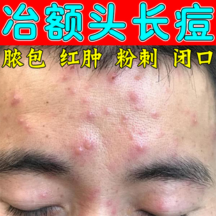 去额头痘痘脸上起小疙瘩长痘痘闭口粉刺去脸部额头下巴痘神器