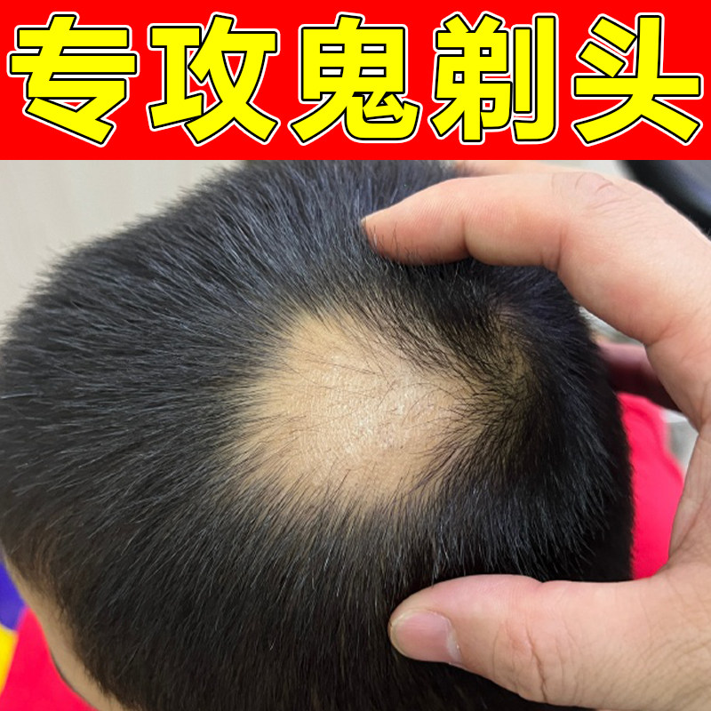 头顶成块脱发掉发突发性斑秃鬼剃头毛囊受损不长头发修护喷剂
