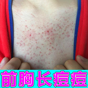 胸前长痘胸口长小红点疙瘩背上脓包前胸后背痘修复膏