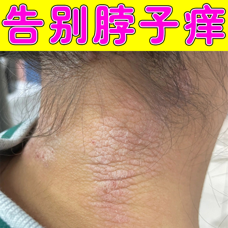 脖子皮肤干燥脱皮痒刺挠泛红脖子出汗多痒长疙瘩痒的受不了