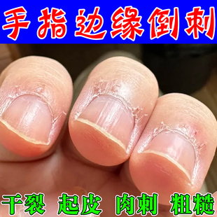手指起倒刺修复受损儿童成人手上干裂脱皮去死皮肉刺疼专用护手霜