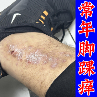 脚踝发痒脚脖皮肤干燥起皮屑痒刺挠角化型越抓越痒专用膏