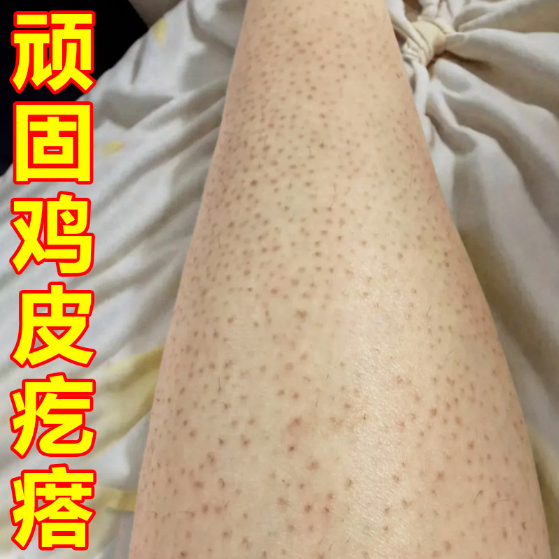 毛周角化疙瘩软膏手臂长小颗粒黑点干燥毛囊堵塞专用霜