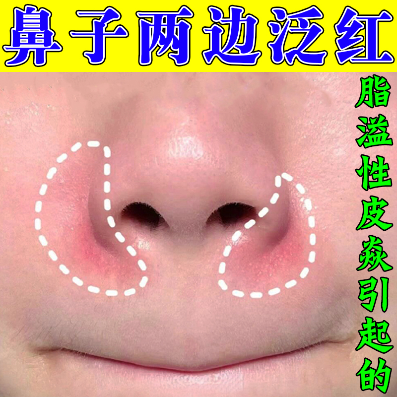 治鼻子两侧发红脱皮鼻翼两边泛红干燥起皮掉皮面部脂溢性皮焱专用