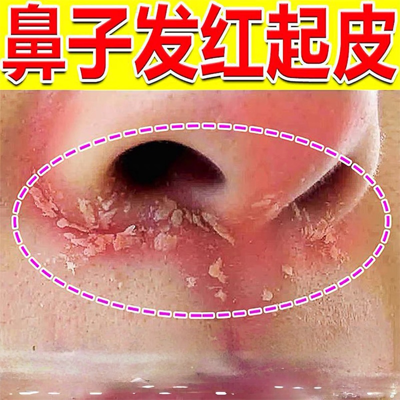 鼻子两侧起皮脱皮发红鼻翼两边泛红干燥修复长痘痘痒膏酒糟鼻软膏