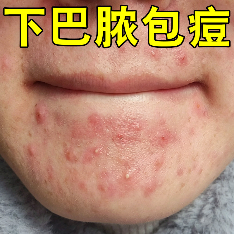 下巴脓包痘闭口粉刺冒白尖红疙瘩皮肤消毒护理（消）