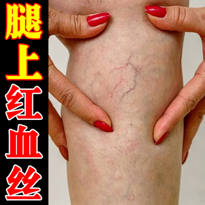 腿上红血丝毛细血管扩张男女性小腿手背手臂青筋凸起血丝腿外用药