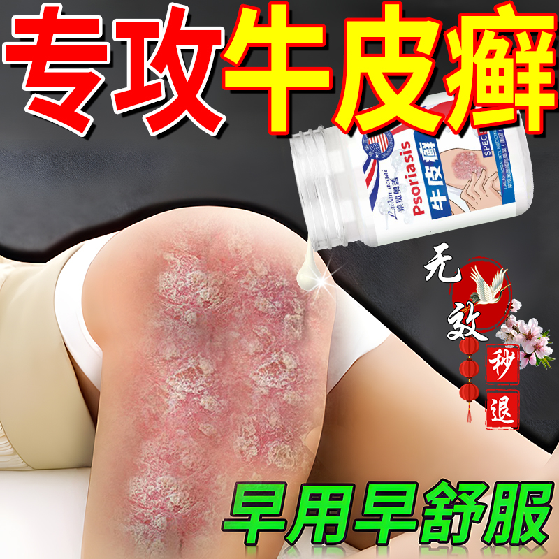 牛皮癣专用膏顽固银屑病真菌感染手足藓股癣皮肤小腿瘙痒止痒去屑
