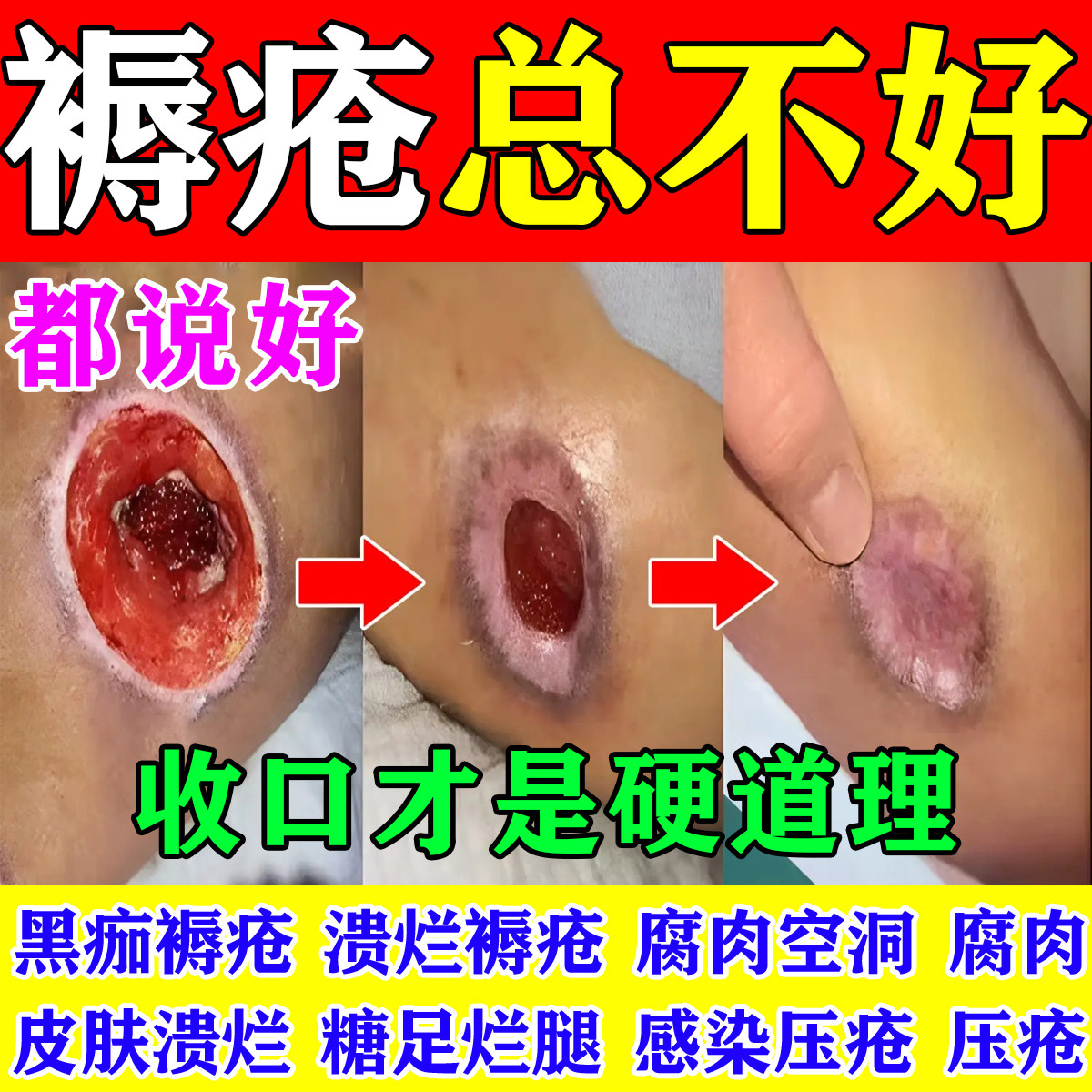 褥疮专用膏老人臀部外用腐烂压疮屁股烂伤口愈合促进长肉去腐生肌