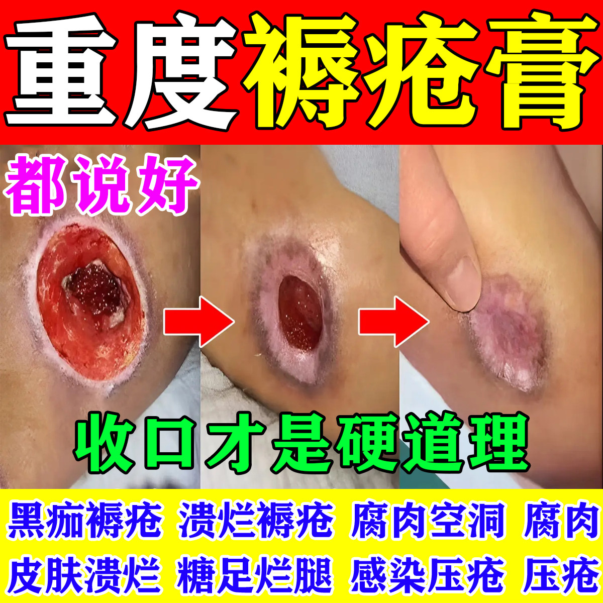 褥疮专用膏老人臀部外用腐烂压疮屁股烂伤口愈合促进长肉去腐生肌