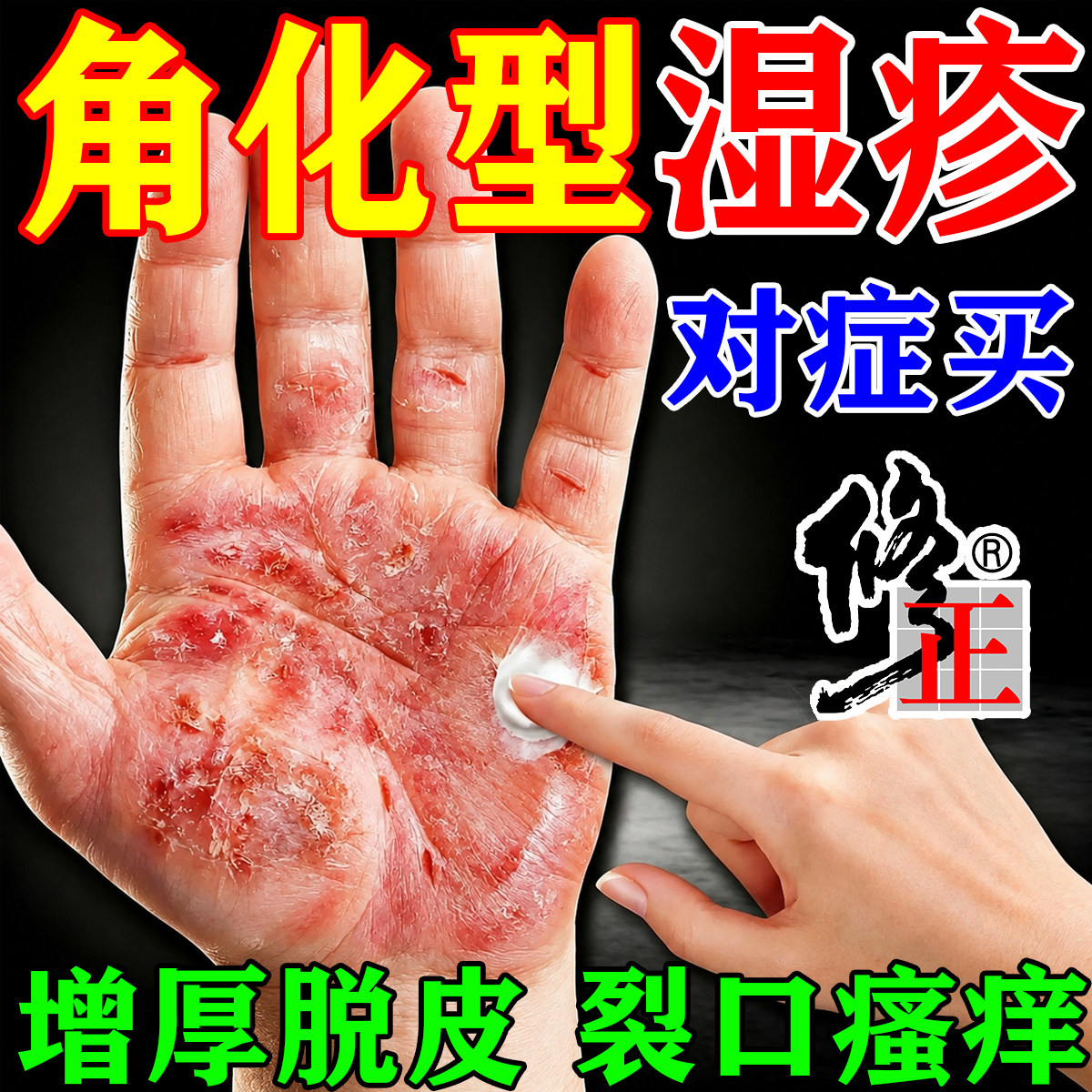 手部角化型湿疹脱皮干裂真菌感染手足部癣膏皮肤粗糙增厚瘙痒喷剂