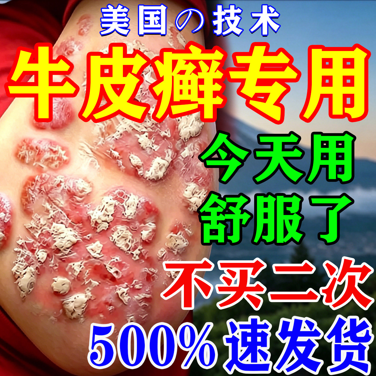 牛皮癣专用膏顽固银屑病真菌感染手足藓股癣皮肤小腿瘙痒止痒去屑