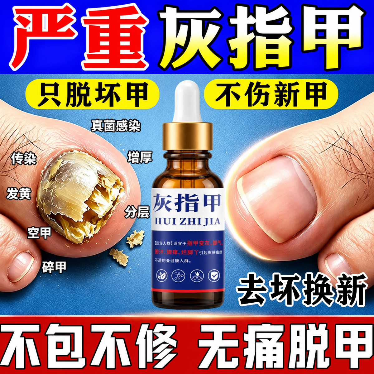 灰指甲专用真菌感染黑指坏甲空甲指甲增厚发硬发黄脱甲去除抑菌液