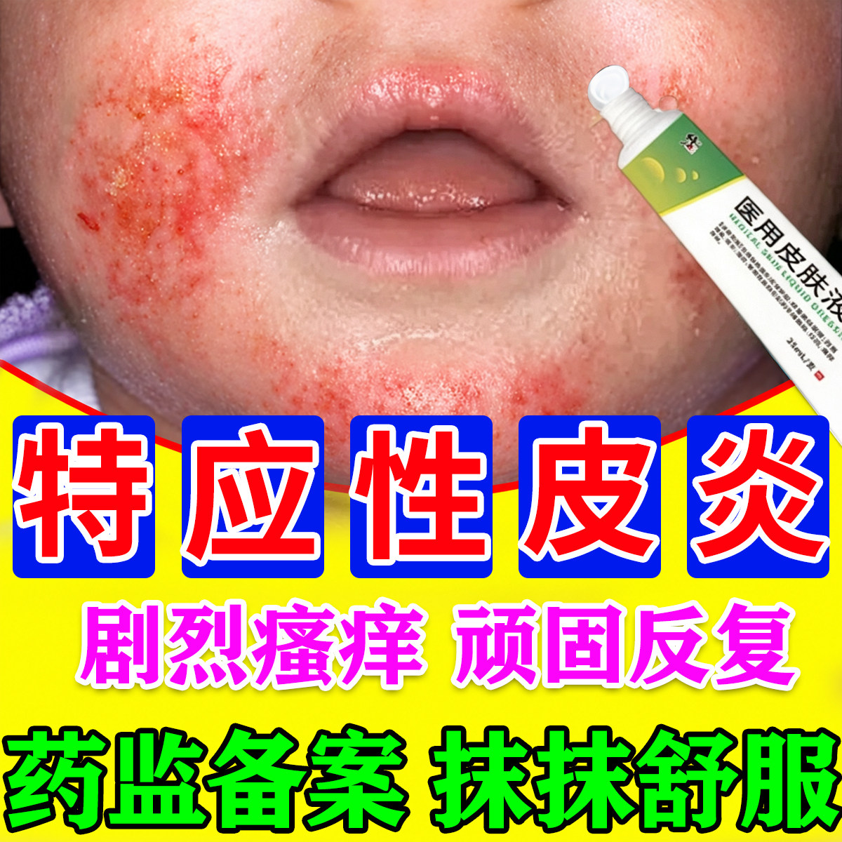 儿童特应性皮炎皮肤干燥痒瘙过敏真菌感染红斑丘疹脱屑专用湿疹膏