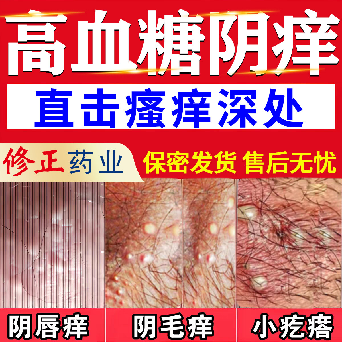 高血糖糖尿病引起外阴瘙痒中老年人妇科炎症私处皮肤痒专用止痒膏