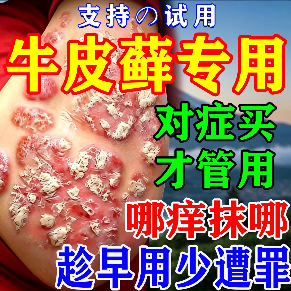 牛皮癣专用膏顽固银屑病真菌感染手足藓股癣皮肤小腿瘙痒止痒去屑