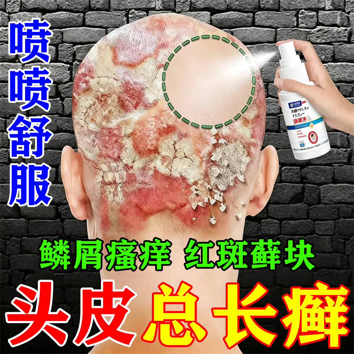 头皮癣专用头皮屑脂溢性皮炎真菌感染头皮痒起疙瘩毛囊炎头藓喷剂