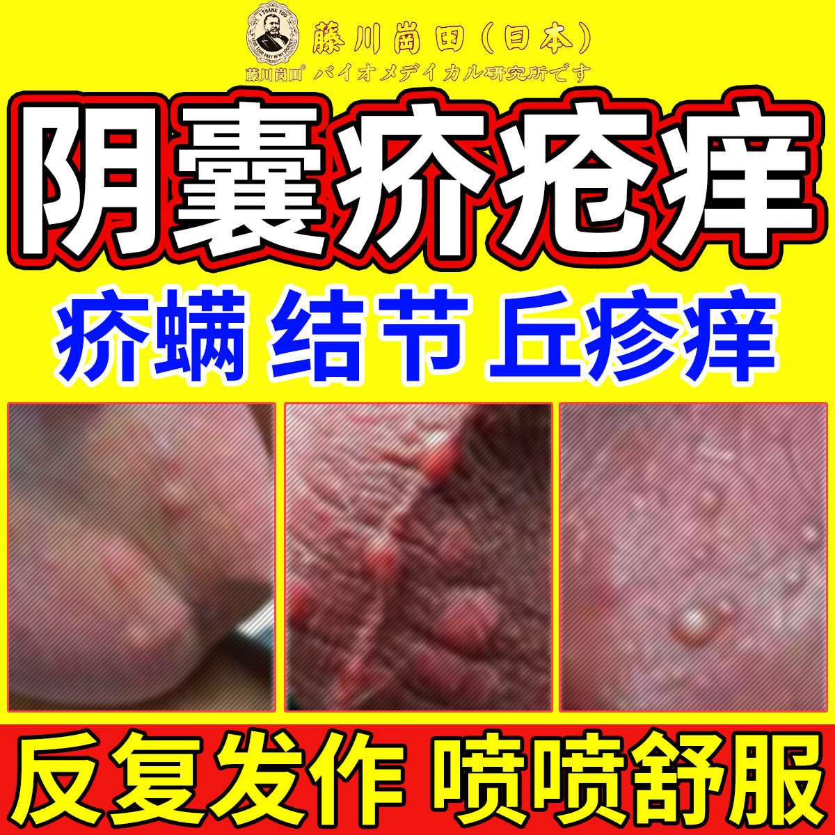 阴囊疥疮结节皮肤痒长红疹硬疙瘩丘疹阴囊疥螨虫阴虱专用止痒喷剂