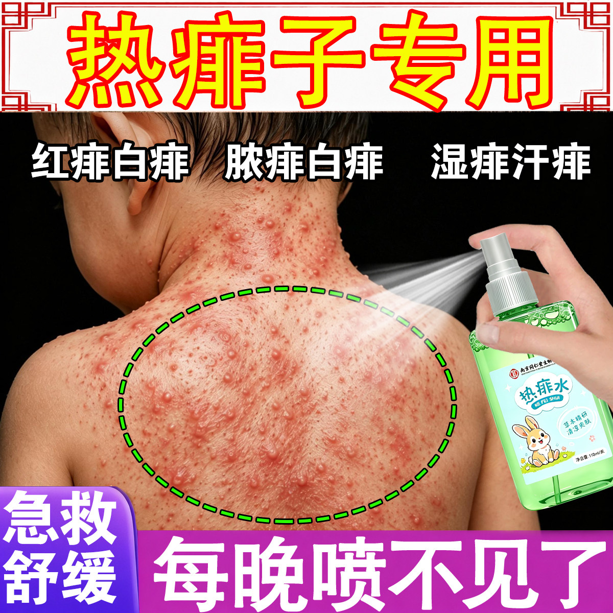痱子去痱止痒宝宝长痱子热疹热痱水宝宝大人通用防菲祛热抑菌喷雾