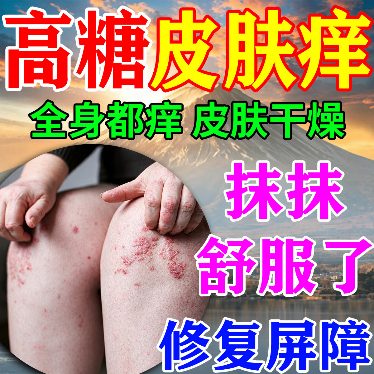 糖尿病皮肤痒专用老年人高血糖皮肤瘙痒外阴阴囊痒干燥脱皮止痒膏