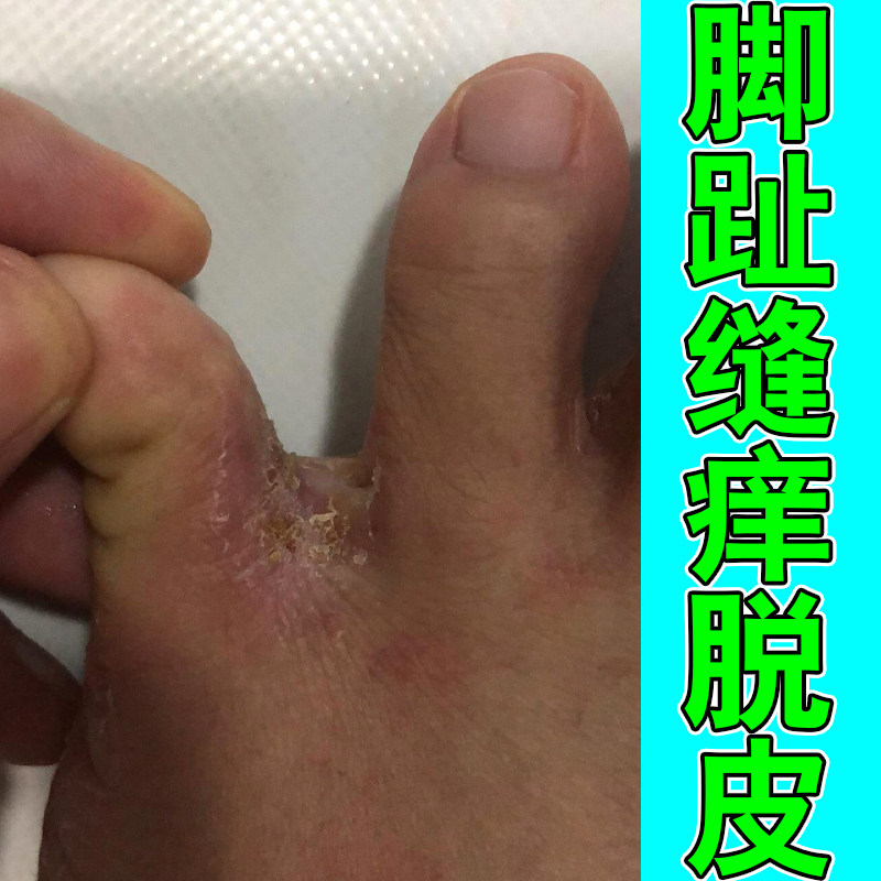 脚趾缝痒脱皮掉屑痒脚底起水泡脚背痒脚趾间发白痒开裂外用草本药