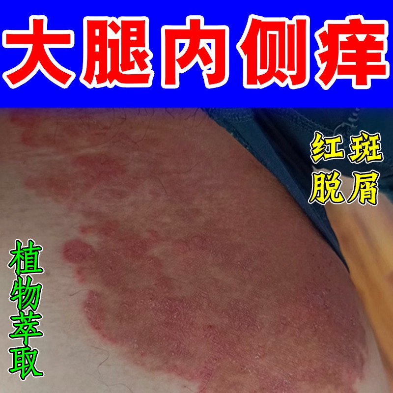 大腿内侧痒男人下面潮湿长红斑过敏长痘起疙瘩痒粗糙红肿干燥草本