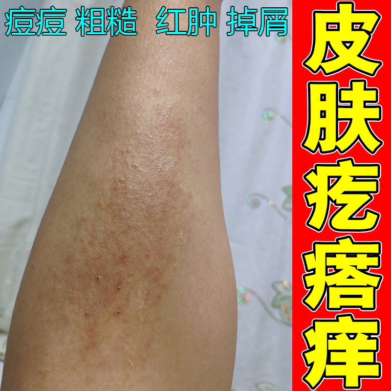 皮肤疙瘩痒身上长红痘痘刺挠抓挠痒过敏性疹子粗糙掉屑修复保湿药
