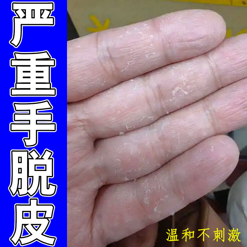 严重手脱皮掉屑粗糙干燥起皮换季手老茧干纹粗糙蜕皮外用修护药乳