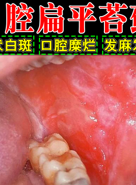 口腔扁平苔白斑粗糙修复药黏膜红肿舌头白色念珠菌溃疡