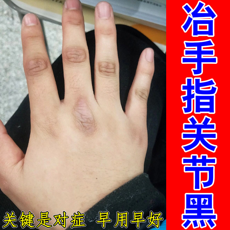 冶手指关节黑皮肤粗糙黑色素暗沉无光膝盖脖子后面黑洗不干净专用