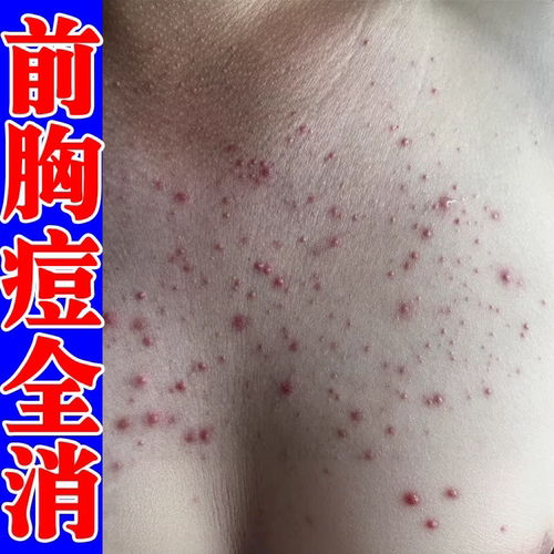前胸后背长痘痘毛囊炎膏药胸前痘痘胸口发红发痒长小红点疙瘩专用