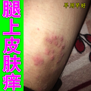 腿上皮肤痒大腿内侧粗糙痒长红疙瘩小腿皮肤痒长痘过敏老人身上痒