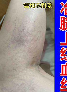 小腿红血丝腿部青筋显露下肢血管突出腿部酸胀沉重腿上丝状红纹膏