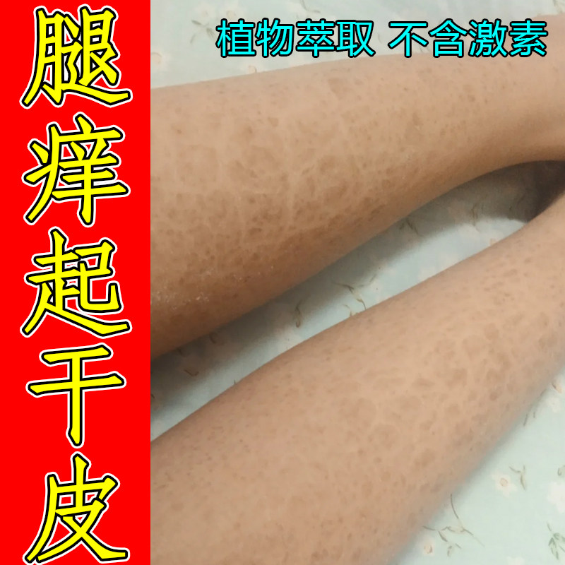 鱼鳞皮全身起皮身体润肤乳小腿蛇皮肤干燥掉皮屑粗糙干纹四肢角质