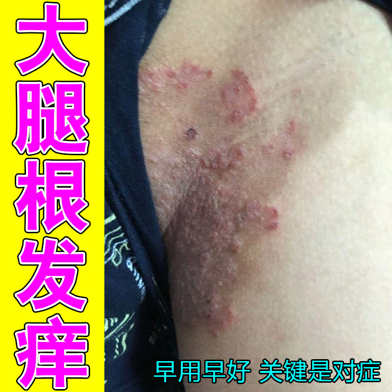 大腿根发痒红肿长红斑过敏痒男人下面痒私处长痘潮湿长圆斑掉屑痒