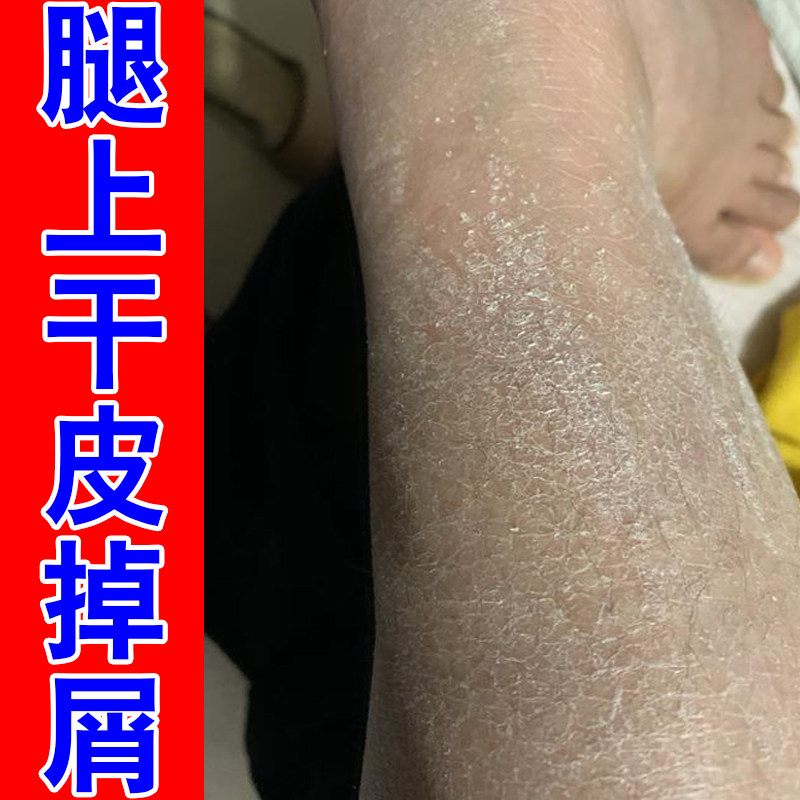 腿上干皮掉屑身上鱼蛇皮肤干燥起皮掉皮屑腿部皮肤干燥鱼鳞补水霜