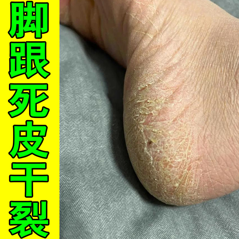 脚后跟死皮干裂角化型鳞屑性脚蜕皮干燥粗糙裂口子专用修护药乳膏