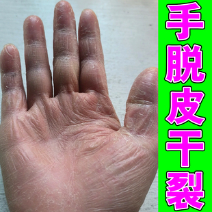 手部皮肤干燥干裂口手粗糙脱皮手足蜕皮角质松懈症疼痛手掌掉皮药