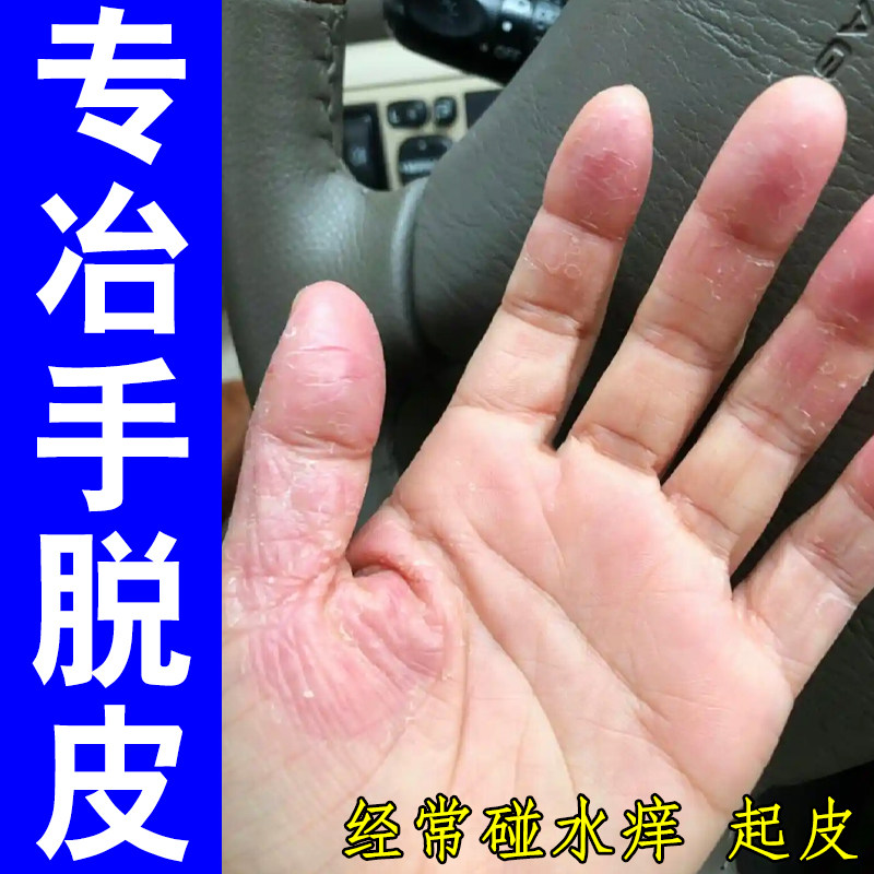 专冶手脱皮真菌手脚蜕皮严重干燥粗糙掉屑红肿过敏痒皮肤干裂口痒