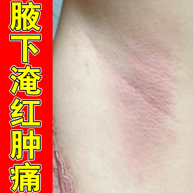 腋下淹红肿痛皮肤干燥蜕皮起红斑过敏神经性换季胳肢窝红疙瘩痘痒