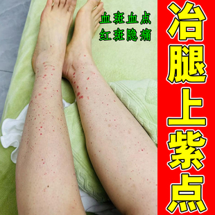 冶紫点皮下出血紫瘀腿上长红点老年性色素瘀斑瘀点单纯性紫点红点