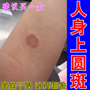 人身上圆斑痒皮肤干燥泛红痒冶起红斑掉屑粗糙干痒起皮修复药乳膏