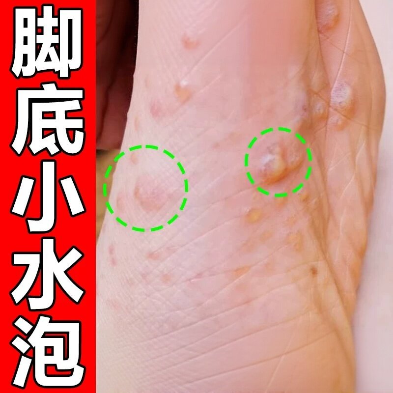 脚底上起小水泡又痒又脱皮脚痒掉皮脚丫药水疱型