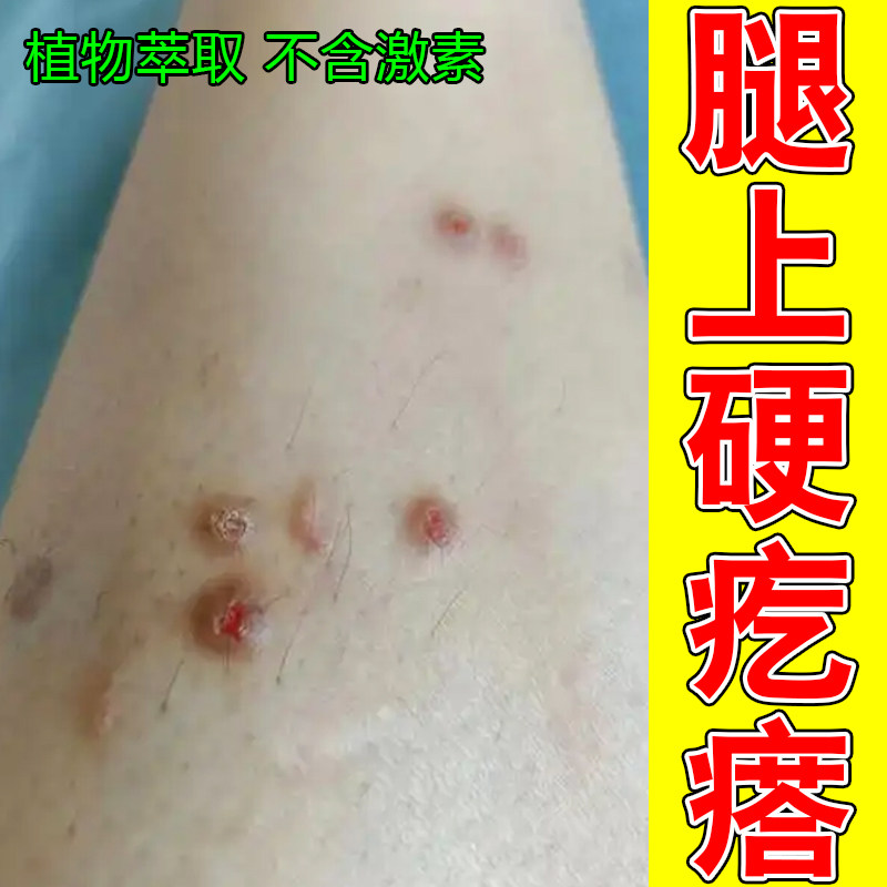 腿上硬疙瘩身上皮肤干燥痒小腿红斑长痘痘顽固脚踝关节痒修护保湿