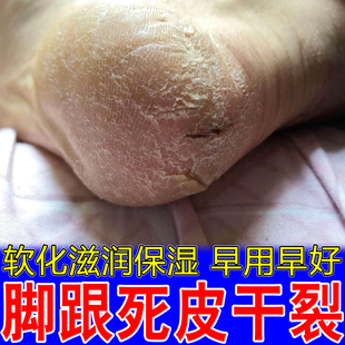 脚跟死皮干裂换季皮肤干燥粗糙裂口子出血皴摸起来麻麻赖赖掉屑膏