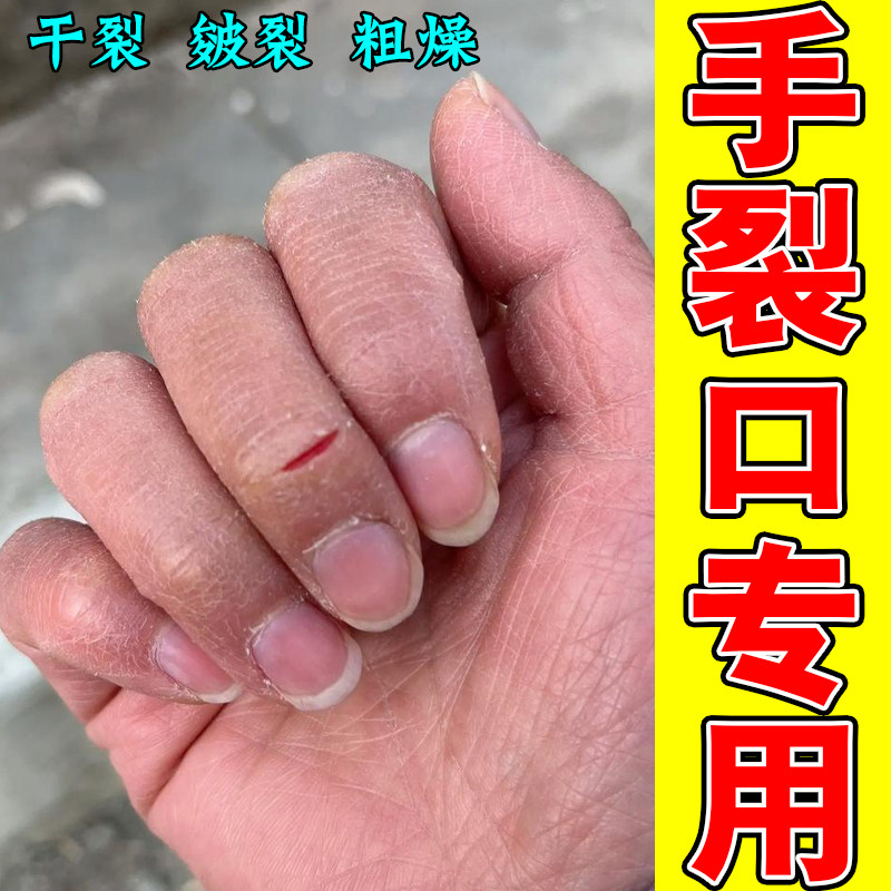 手裂口专用皮肤干燥粗糙皴裂皲裂真菌感染手指头开裂指缝缺水脱皮