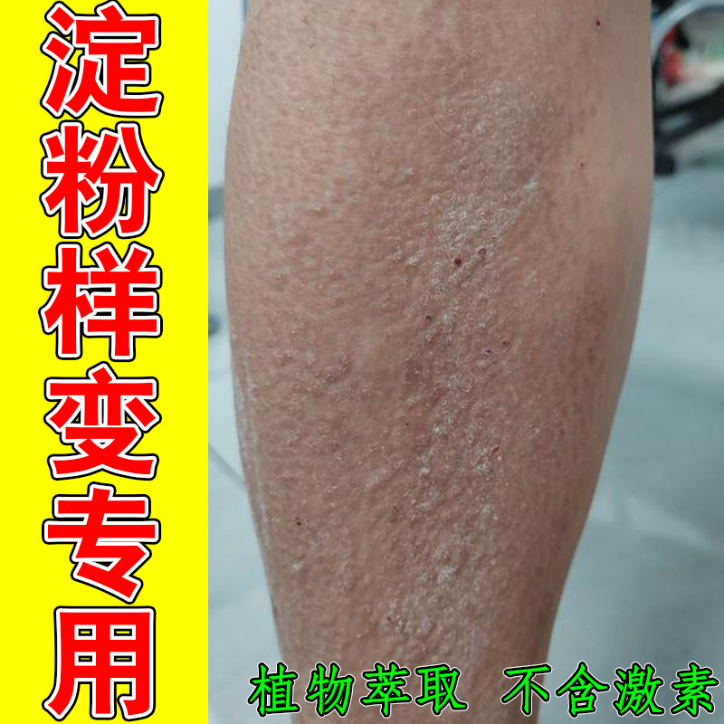 小腿粗糙起硬皮小疙瘩后背褐色色素斑块皮肤干痒起皮角质增厚肌肤