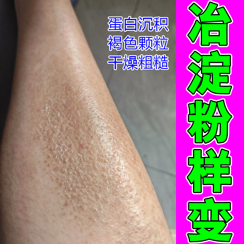 皮肤干燥粗糙褐色沉积顽固后背黑色素沉淀小腿疙瘩痒药乳